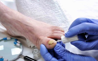 Onychomycosis Treatment: Information About Tavaborole
